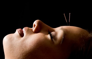 Acupuncture - New Clients - 20% Savings